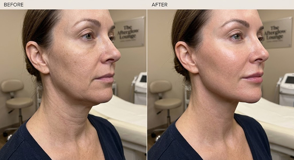 Before and after: SkinWave facial results showing improved skin texture and radiance